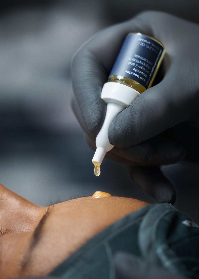 microneedling with exosomes