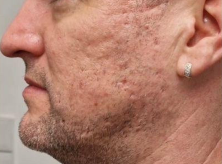Before photos of exobooster microneedling on acne scarring
