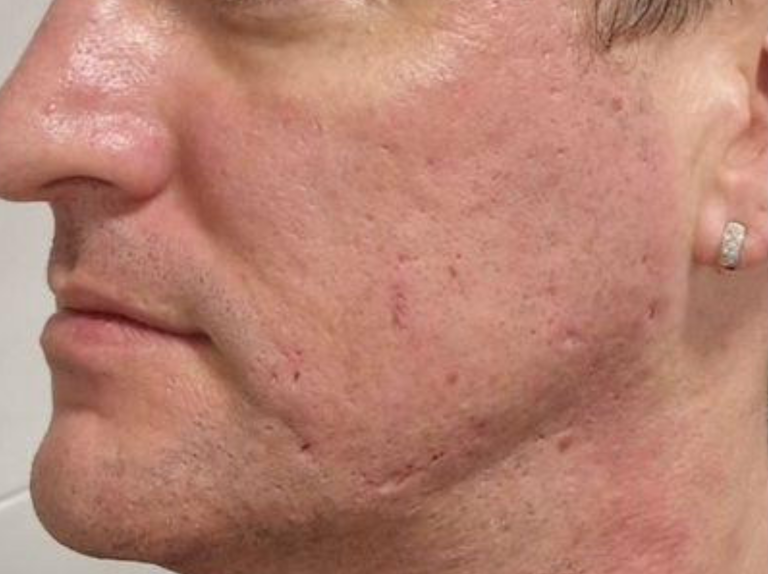 After photos of exobooster microneedling on acne scarring